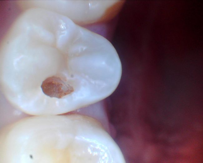 虫歯は穴があいてから（自分で気づいてから）治療では手遅れ？ クレア歯科クリニック｜杉並区阿佐ヶ谷北